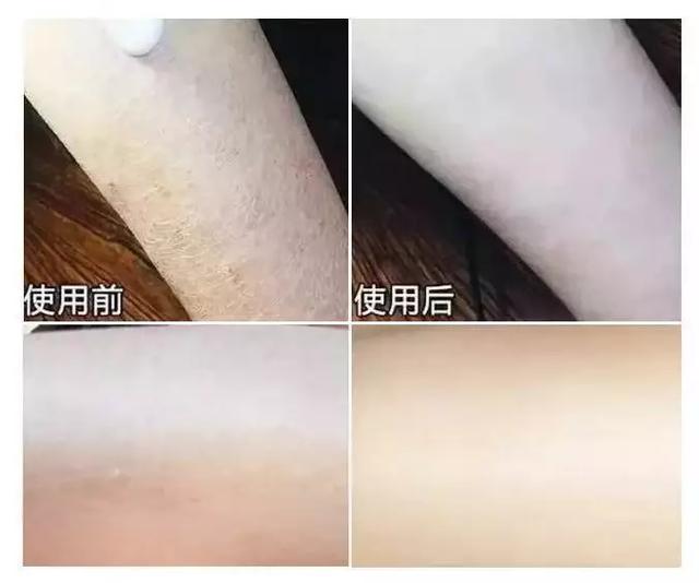 女生冬天腿上为什么会鸡皮肤很痒