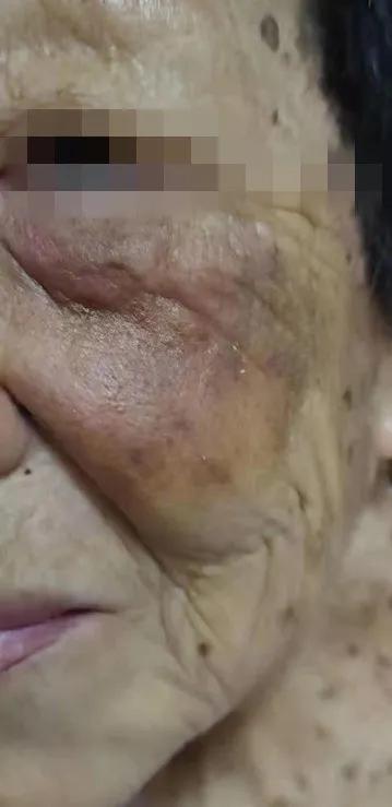 角化层鳞状细胞癌