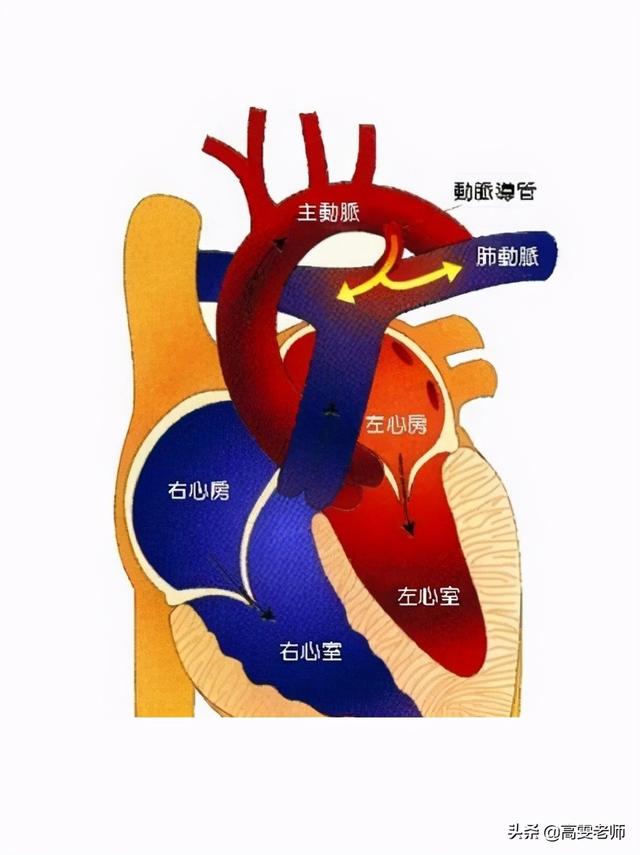法洛四联症的患儿包括四种畸形肺动脉的狭窄,右心室的肥厚,室间隔的