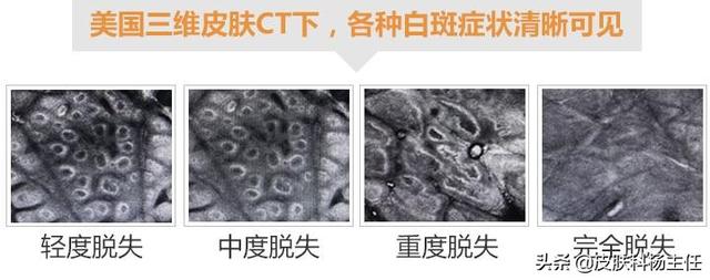 皮肤科皮损取材检查是什么意思