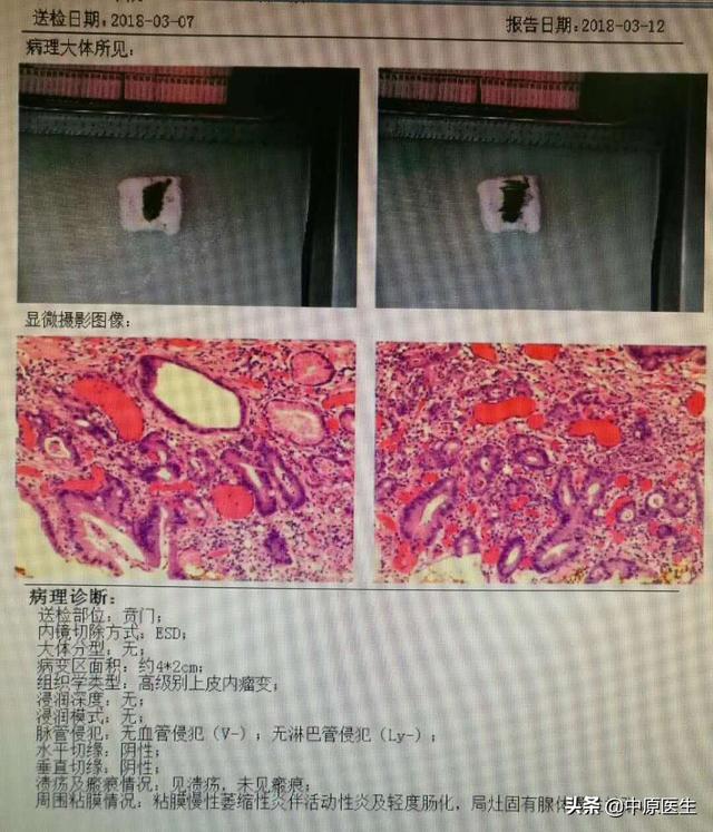 贲门下段角化一年半能病变吗