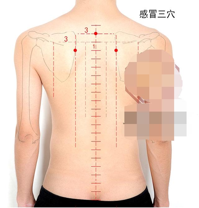 中医针灸感冒、上呼吸道感染疾病处方2