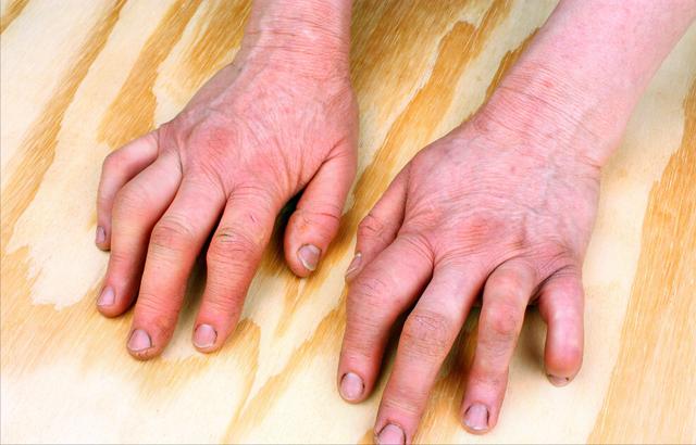 吃饭很重要，吃不对竟然能加重类风湿病情，这并非危言耸听