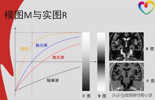 mri检查婴儿t1hi高是什么意思