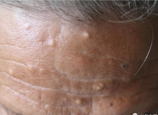 肥厚性日光性角化症