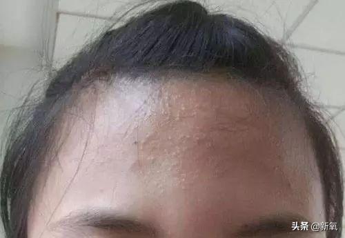 明星脸部毛周角化