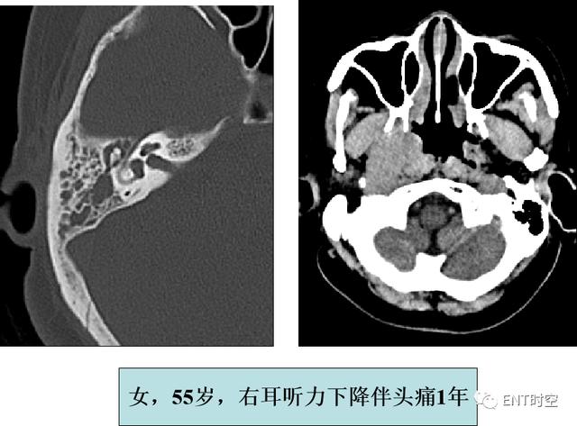 鼻咽鳞状上皮增生伴不全角化