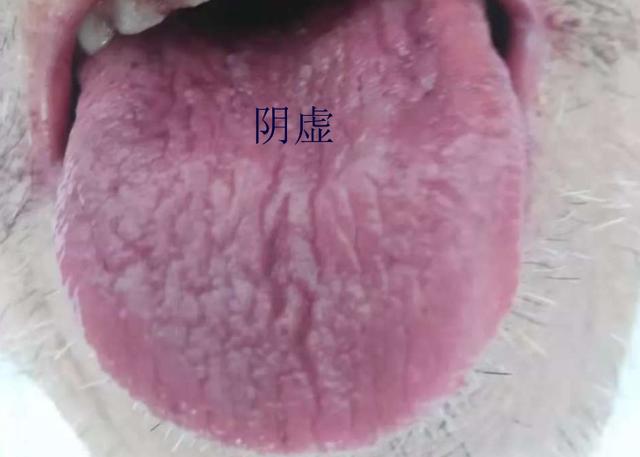 舌头有裂纹就是阴虚吗？教你形象地认识四种裂纹舌，十种舌象