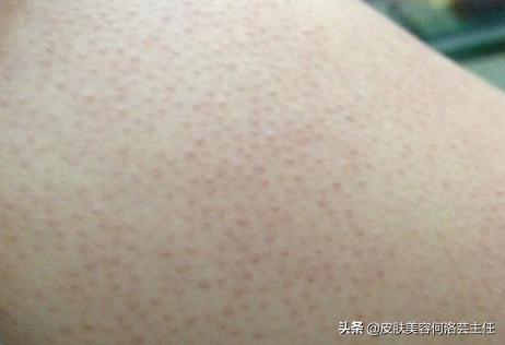 果酸可以治疗鸡皮肤吗