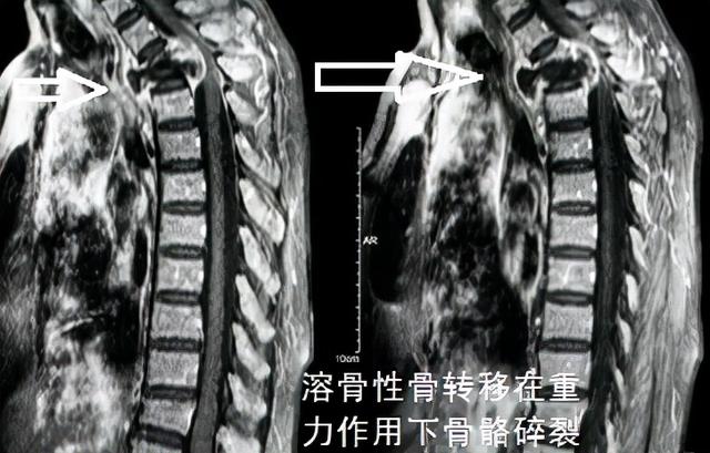 什么樣的疼痛應該小心是骨轉移？