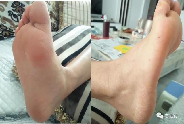 角化型手足癣用什么中药泡好
