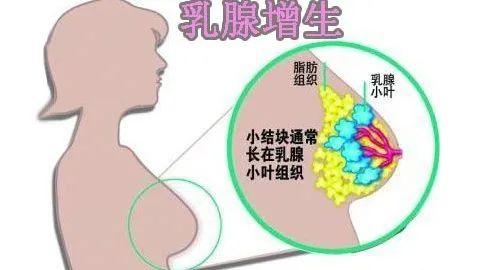 乳腺增生 消癖汤