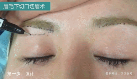 35岁 55岁上眼皮耷拉 松 医生说提眉手术还不错 太阳信息网