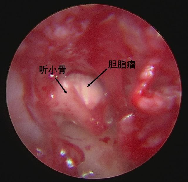 手术前手术后儿童外耳道,中耳胆脂瘤是耳科常见疾病,常以耳内肉芽