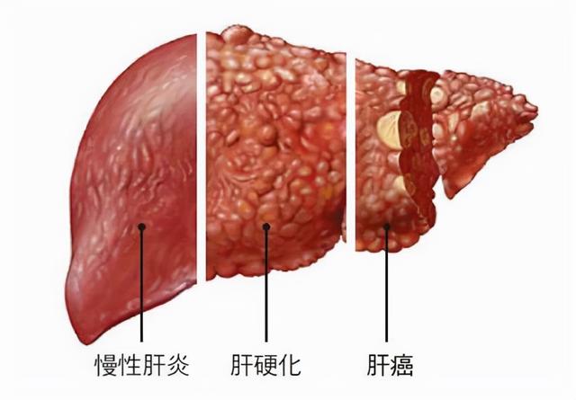 3种蔬菜已被列入伤肝“黑名单”，希望大家及早远离