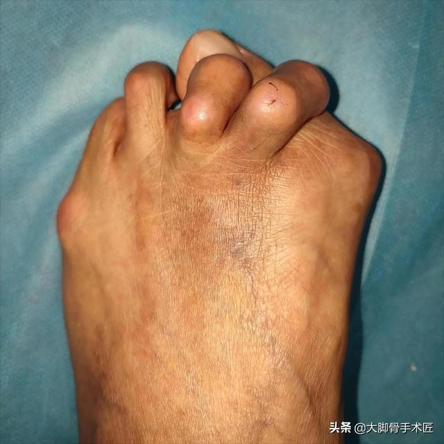 大腳骨踇囊炎,前足等疼痛,人體自我保護代償性用足跟負重,行走姿勢