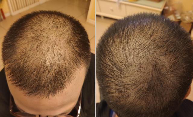 头面油腻、肥胖、脱发怎么办？中医让你避免“三十而腻”