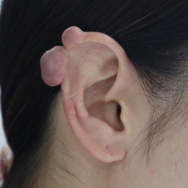 耳洞长肉芽怎么办