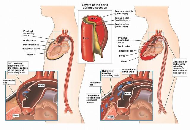 后背疼会不会是心脏病？心血管医生：这2种情况要注意