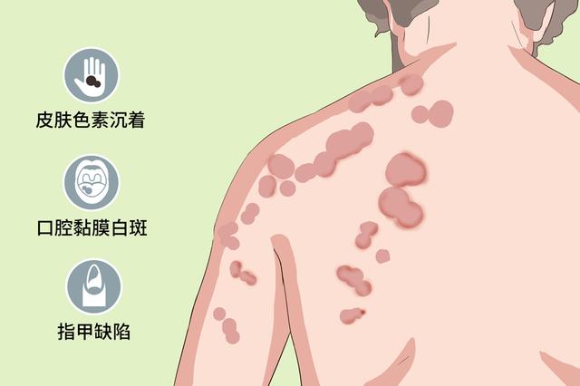 白角化症能治愈吗