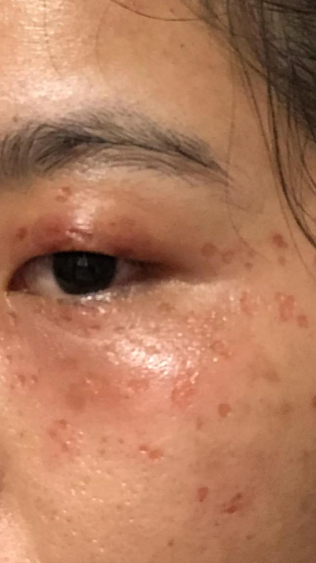 不用擦东西脸上脂肪粒怎么去掉