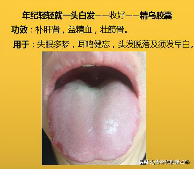 咽炎、高脂血症，四肢麻木，10个中成药，年过35岁后要收藏备好