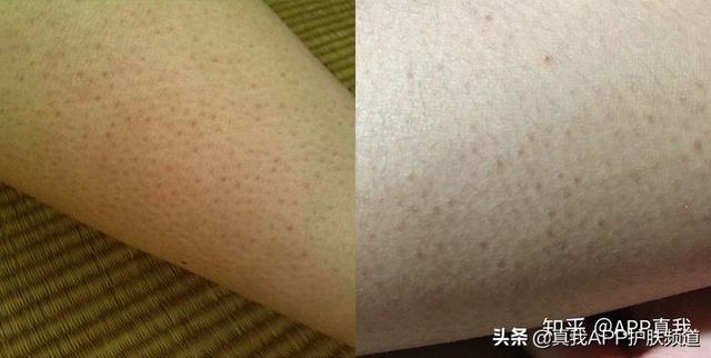 专家推荐祛除鸡皮肤