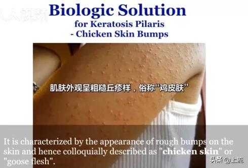 汗毛长不出来成了鸡皮肤
