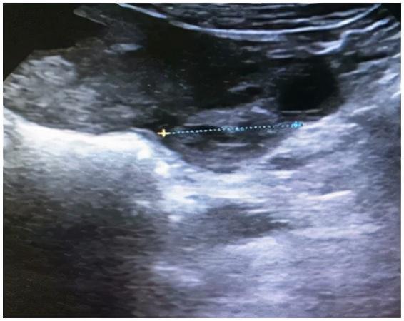 双胞胎隔“宫”相望，医生“攘外安内”