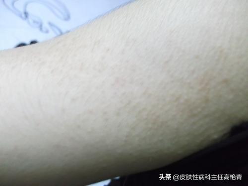 宝宝脸上毛周角化症
