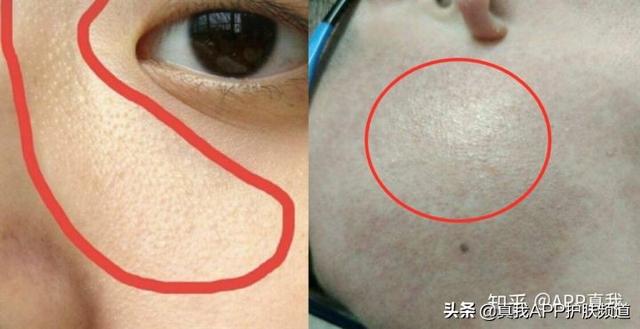 毛周角化和微粉刺