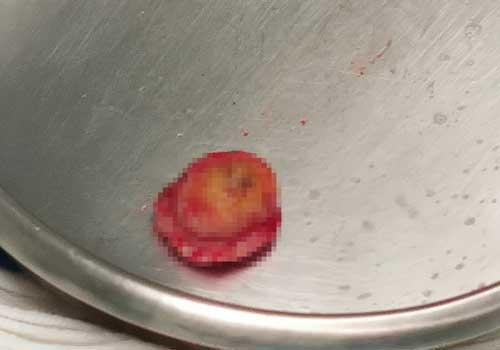 角化瘤切除是大手术吗