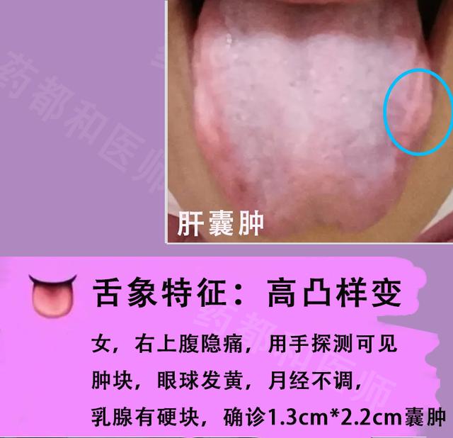 胆囊息肉，胆结石，肝囊肿？6种肝胆病变，看看舌象就知道