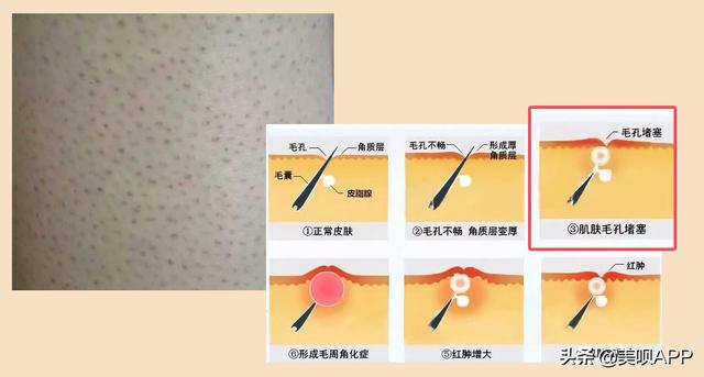 毛囊角化症与毛周角化症的区别