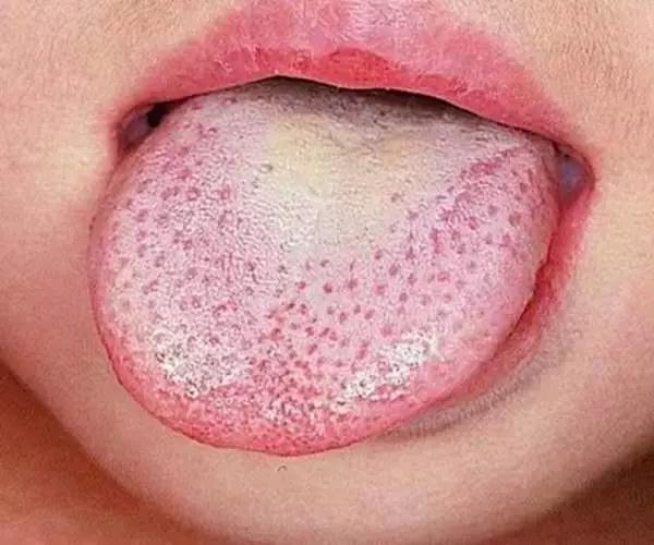 脖子皮肤像鸡皮是hpv吗