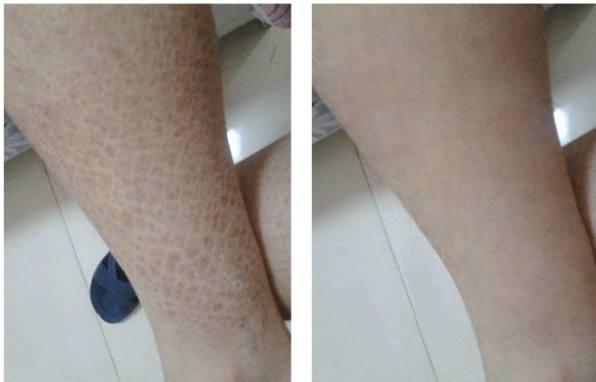 毛周角化症的多发季节