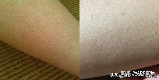皮肤突然出来一片红色鸡皮