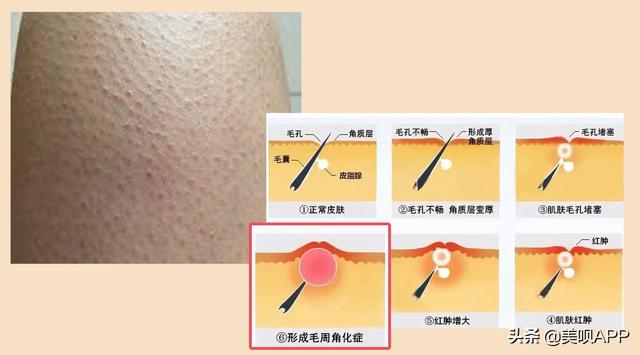 有毛周角化症怎么治