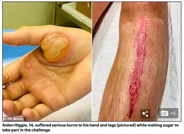 可怕！悉尼一男孩模仿《鱿鱼游戏》导致重伤，恐进行皮肤移植