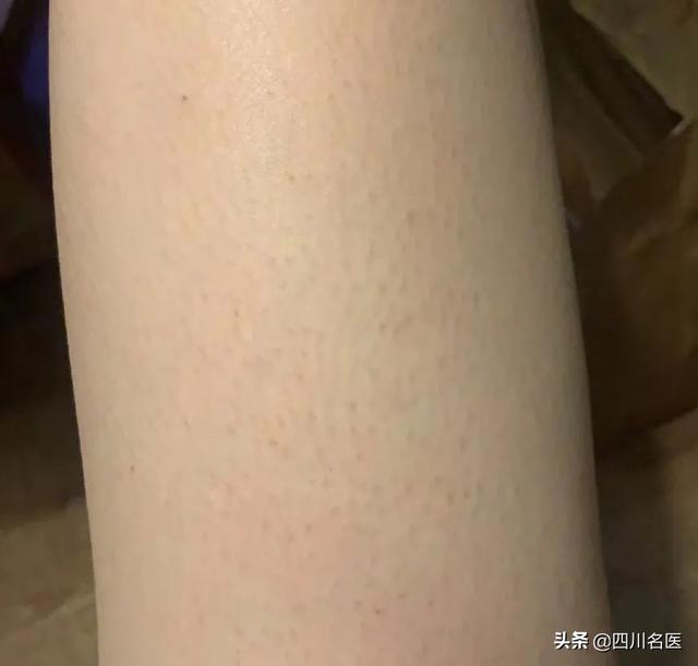 脸毛周角化