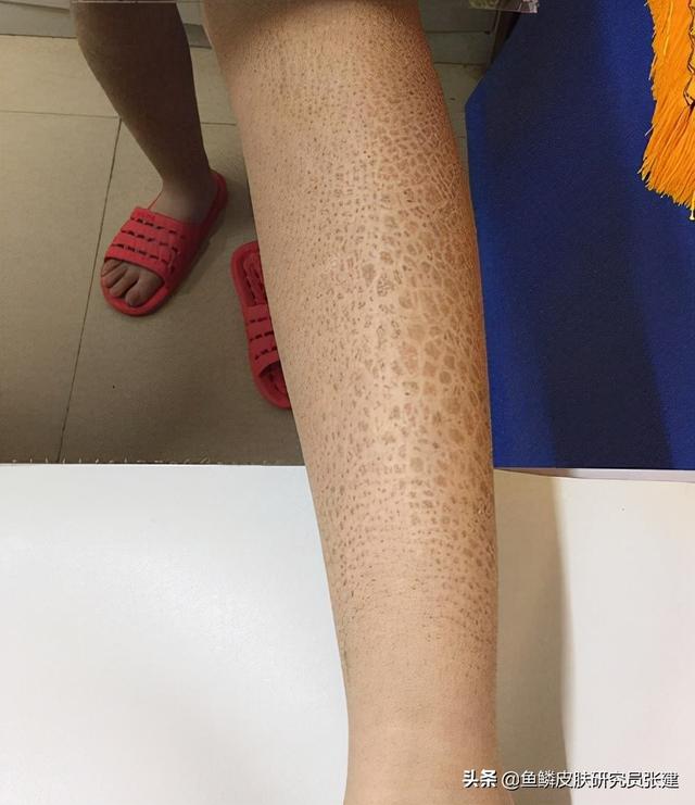 一直困擾我的魚鱗病終於解決了 這些話想對同樣有魚鱗皮膚的你說 Kks資訊網