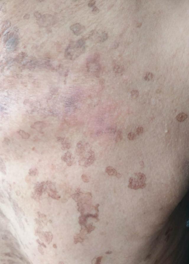 尿素霜治汗孔角化症吗