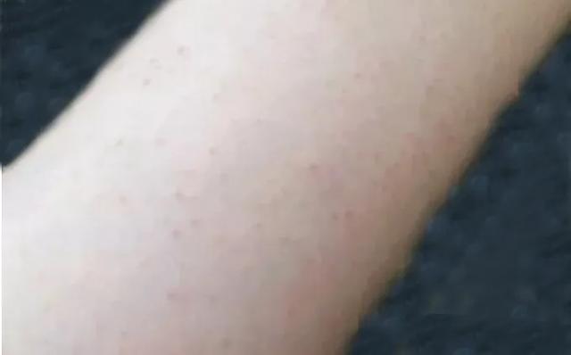 皮肤鸡皮明显