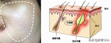 后天鸡皮肤怎么形成的