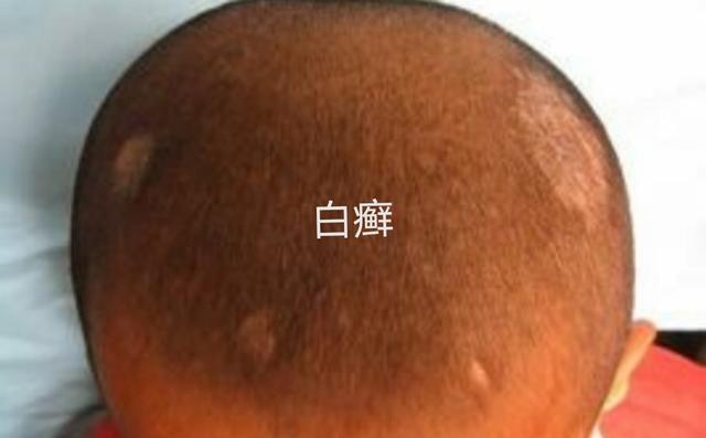 孩子得了头癣怎么办？