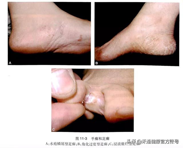 脚痒有水泡怎么办