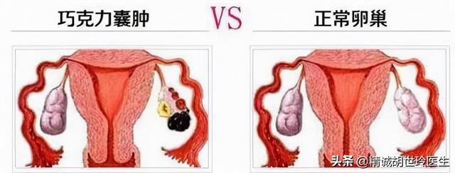 什么是巧克力囊肿？巧克力囊肿可以做试管婴儿吗？