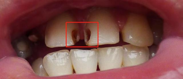 即使已经产生了蛀牙,也是可以治疗和修复的.