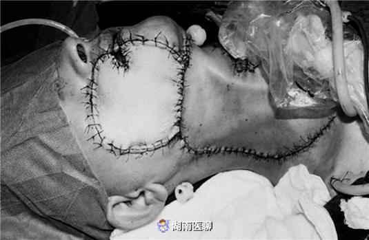 口腔黏膜角化是口腔黏膜变厚了吗