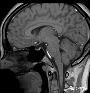 鼻咽鳞状上皮增生伴不全角化